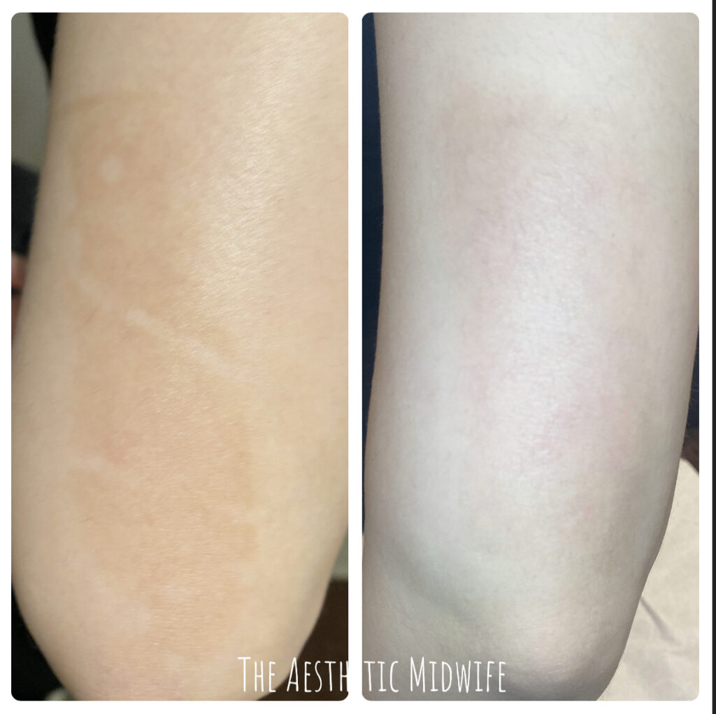 Mesotherapy of pigmentation and scar treatment