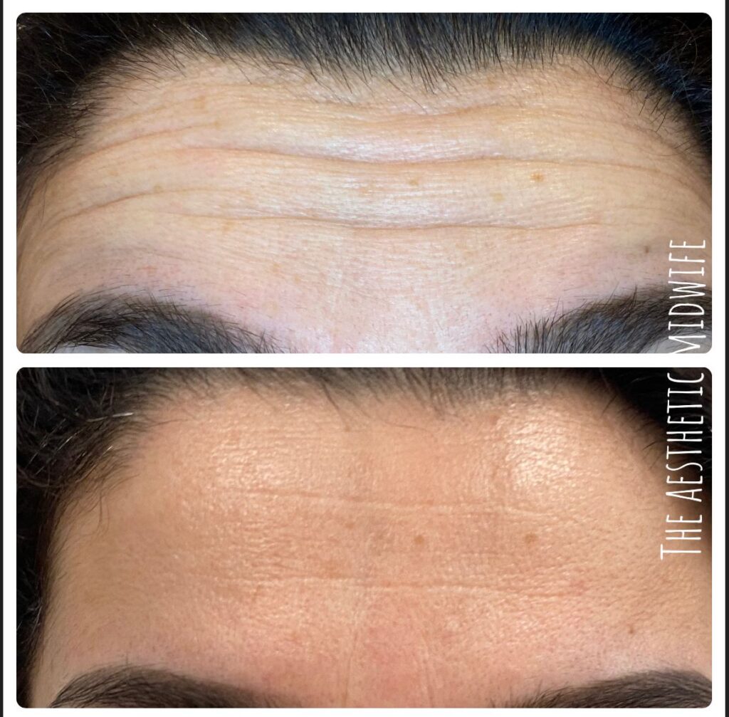 anti wrinkle injections effects